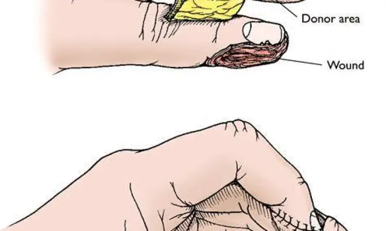 Penanganan medis jempol terjepit