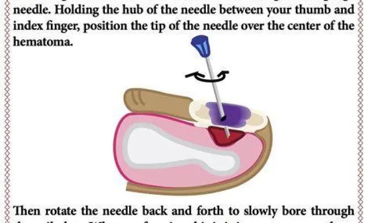 Hematoma Subungual Kondisi kuku hitam akibat terjepit